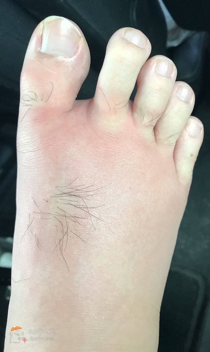 蜈蚣脚疤痕图片